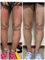 アトピーなどのアレルギーの場合も、食事などの生活習慣を制限せずに、体を良い状態へと導けます